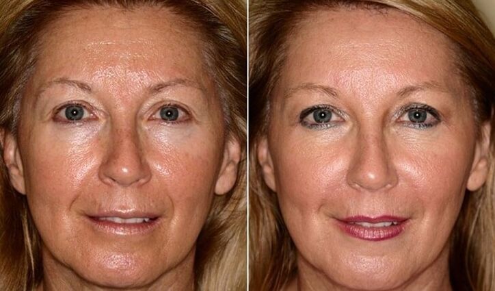înainte și după întinerirea pielii feței la domiciliu